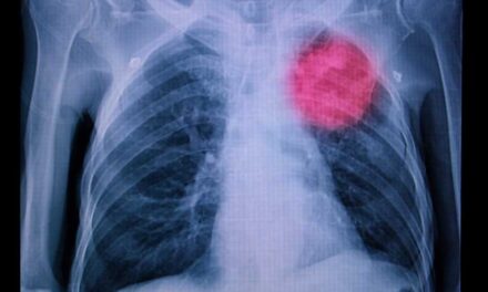 Novo medicamento reduz risco de morte de pacientes com câncer de pulmão em 51%