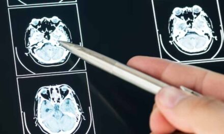 Mesmo casos leves de Covid-19 causam alterações no cérebro, aponta estudo