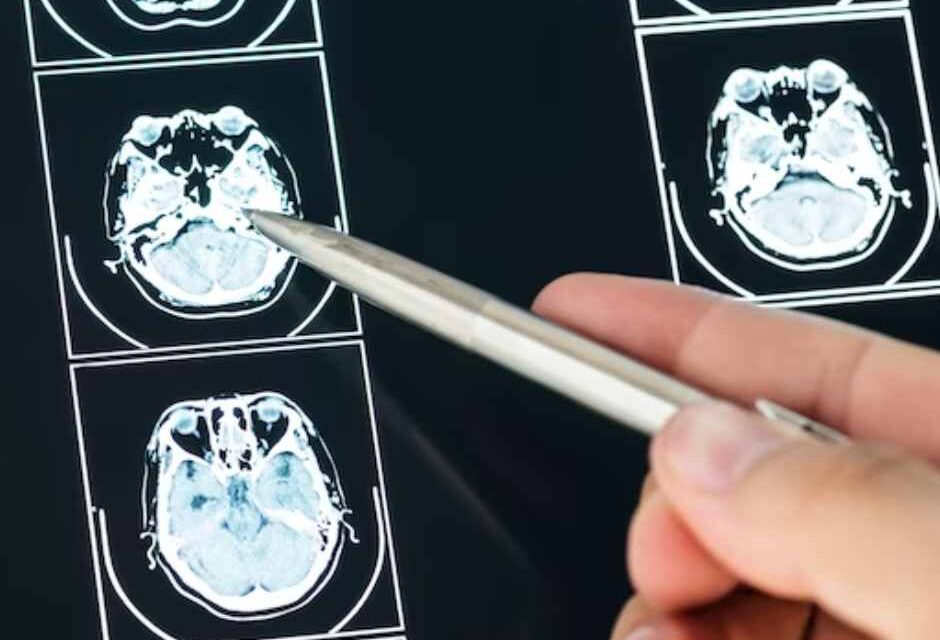 Mesmo casos leves de Covid-19 causam alterações no cérebro, aponta estudo